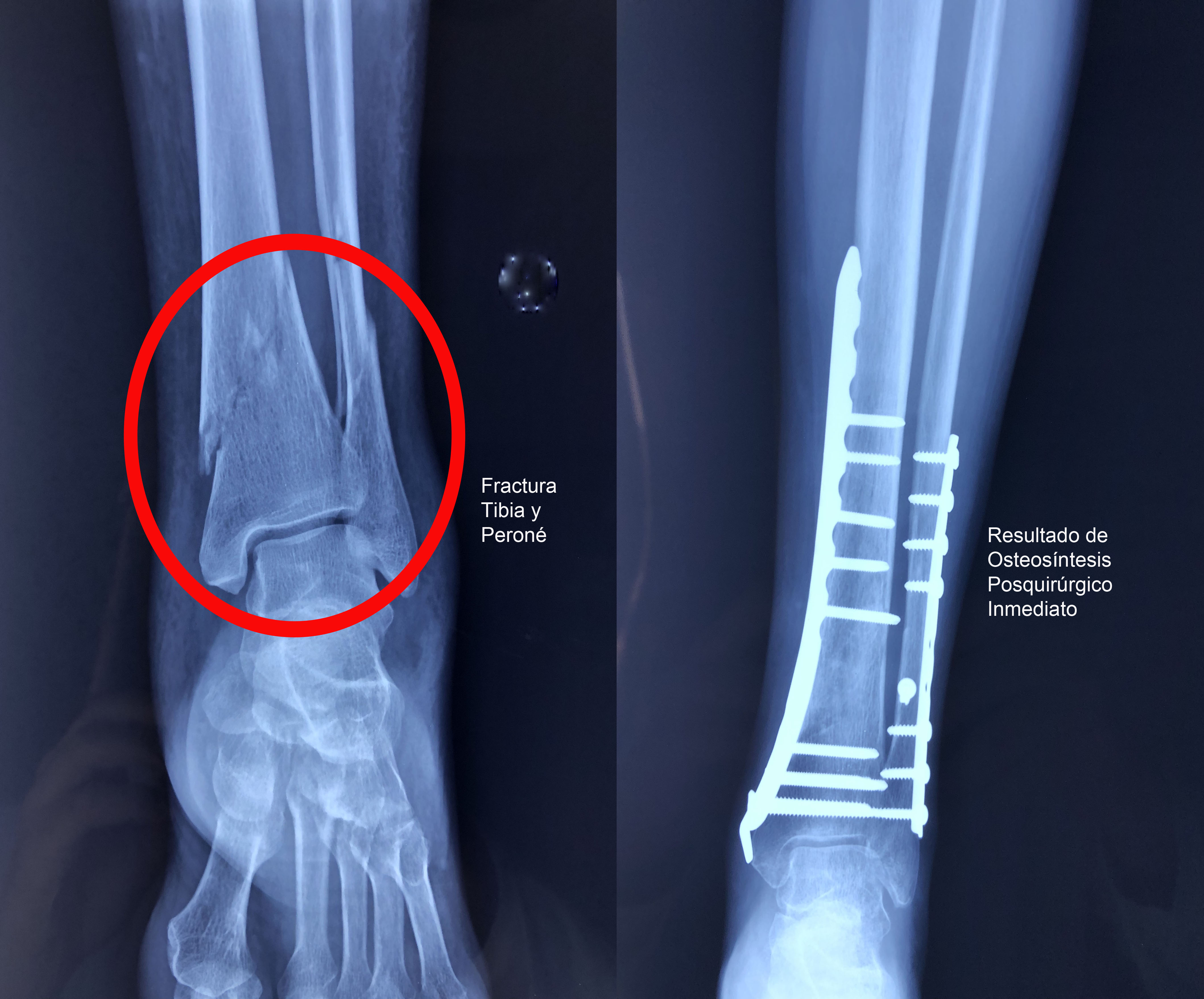 Fractura-de tibia y perone